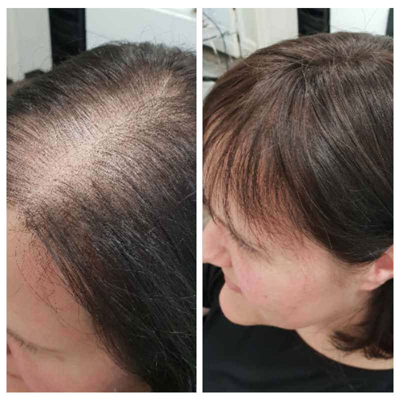 Haarverdichtung bei Alopezie - Berlin Steglitz